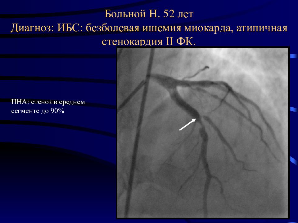 Пна. Тахисистолическая ишемия миокарда. Безболевая ишемия миокарда. ИБС безболевая ишемия миокарда. Безболезненная форма ИБС.