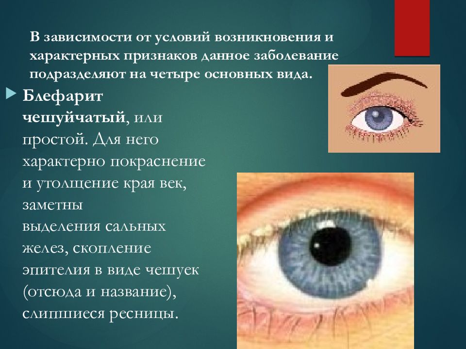 Лечение блефарита. Воспалительные заболевания век блефарит. Блефарит век чешуйчатый. Чешуйчатый блефарит характеризуется.