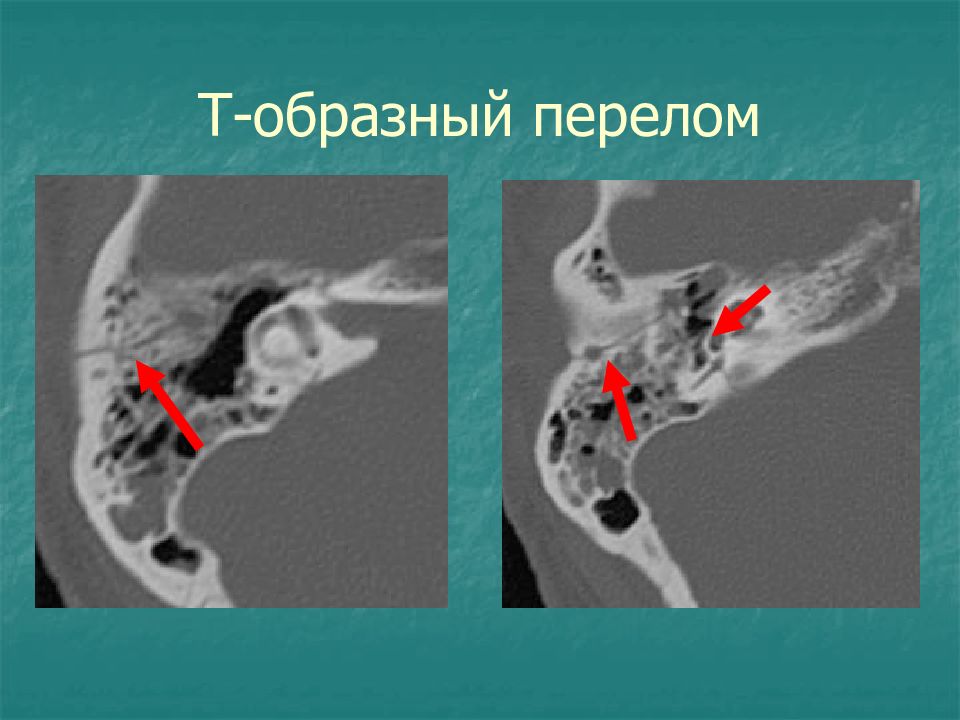 Пирамида височной кости кт