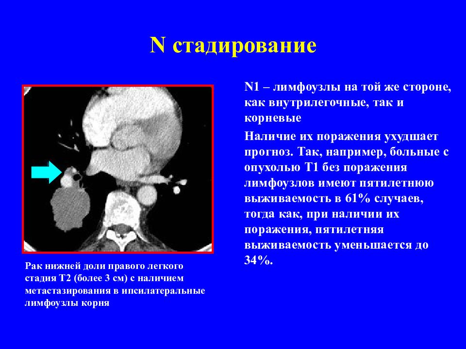 Лимфоузлы при раке легкого