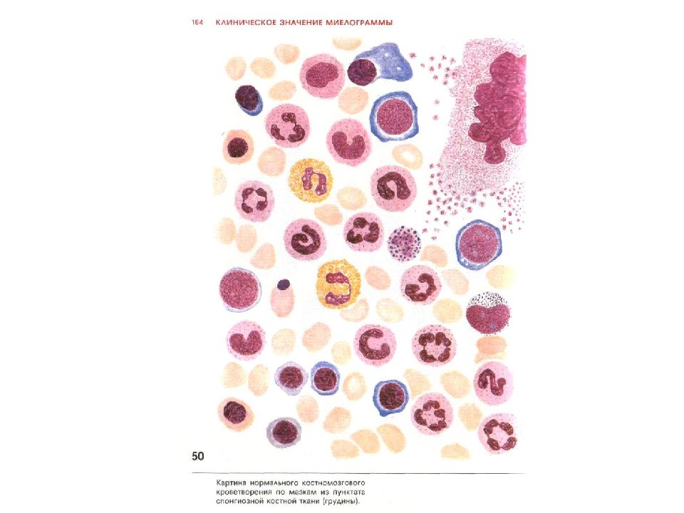 Миелограмма костного мозга. Лейкопения миелограмма. Миелограмма нормобласты. Бласты в миелограмме. Миелобласт в норме.