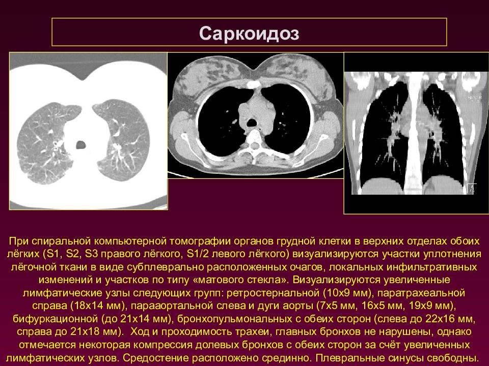 Кт картина саркоидоза легких
