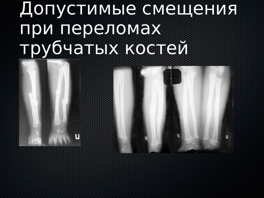 Смещение кости. Допустимые смещение кости. Допустимое смещение при переломе. Смещение отломков трубчатых костей.