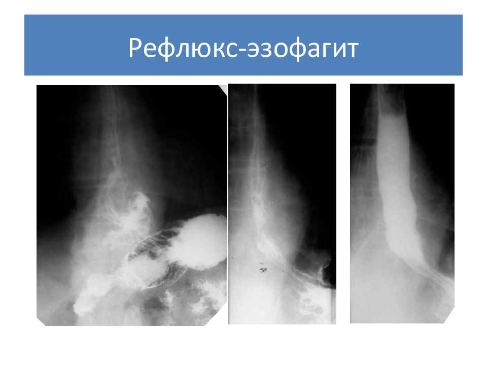Заброс в пищевод. Рефлюкс эзофагит пищевода рентген. Желудочно пищеводный рефлюкс рентген. Дистальный неэрозивный рефлюкс-эзофагит. Рентген при рефлюкс эзофагите.
