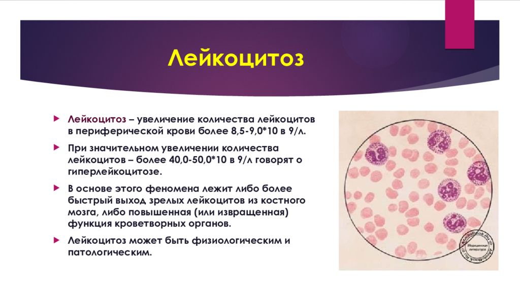 Что значит лейкоцитоз. Лейкоциты периферической крови. Болезни связанные с лейкоцитами. Увеличение количества лейкоцитов. Лейкоцитоз в крови.