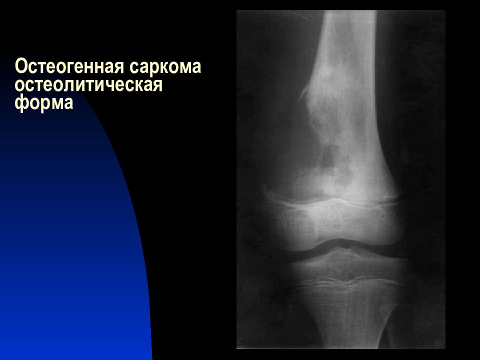 Остеогенная саркома. Рентген остеогенная саркома кости. Остеогенная остеолитическая саркома. Остеогенная саркома остеолитическая форма. Остеогенная саркома бедренной кости рентген.