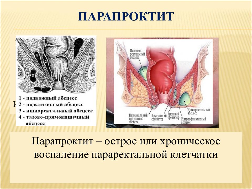 Парапроктит и свищи прямой кишки презентация