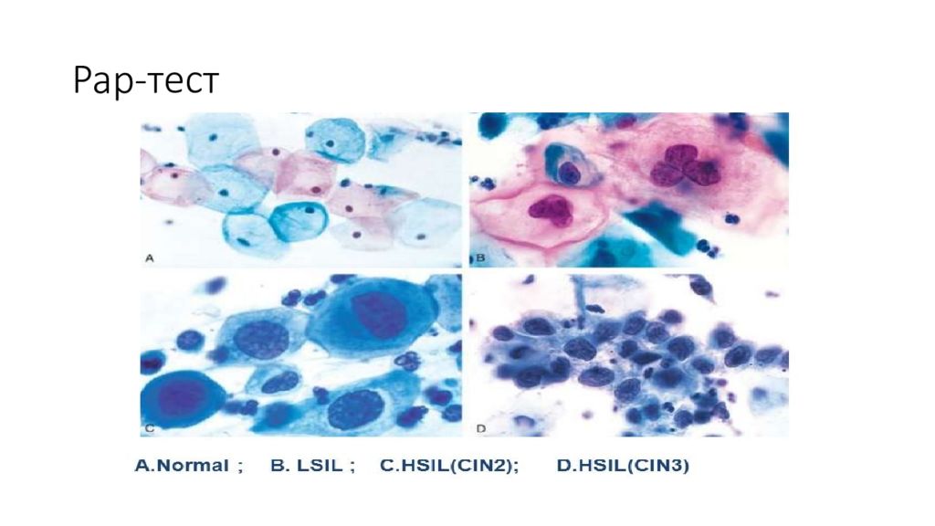 Мазок по папаниколау. Цитология Папаниколау. Цитология мазков PAP тест. Папаниколау окрашивание мазков. Окраска мазков по Папаниколау.
