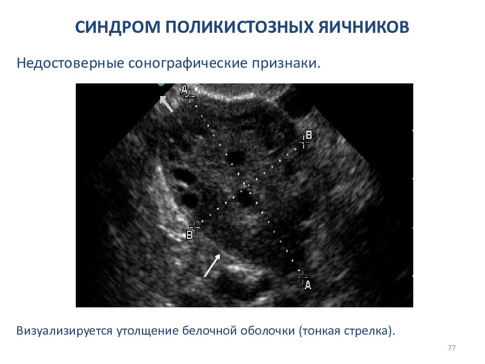 Поликистозные яичники симптомы. Поликистозных яичников. СПКЯ протокол. Синдром поликистозных яичников УЗИ. Синдром поликистозных яичников УЗИ признаки.