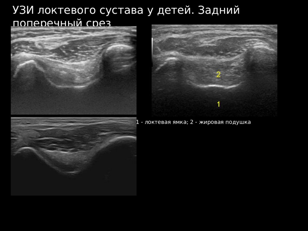 Узи колена. УЗИ мягких тканей локтевого сустава УЗИ анатомия. Локтевой сустав УЗИ Диагностер. Патология локтевого сустава на УЗИ.