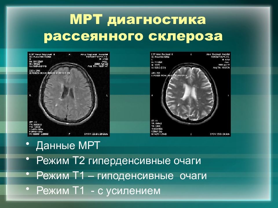 Мрт диагностика рассеянного склероза