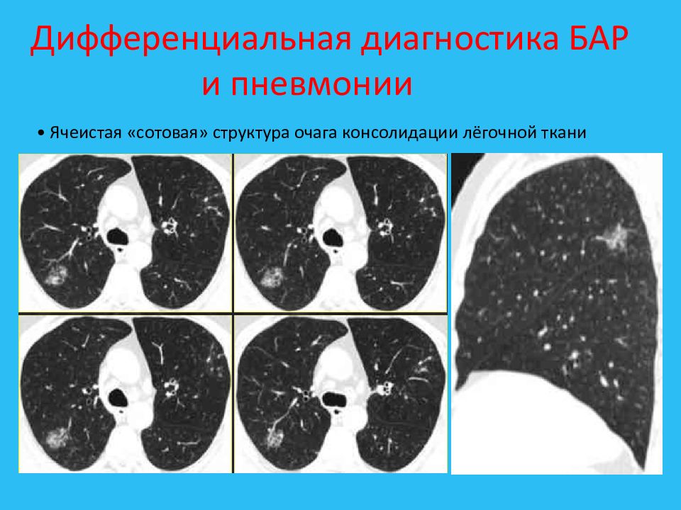 Очаги на кт легких форум. Консолидация легочной ткани на кт. Участок консолидации легочной ткани на кт. Очаги консолидации в легких на кт. Участок консолидации легочной ткани что это такое.