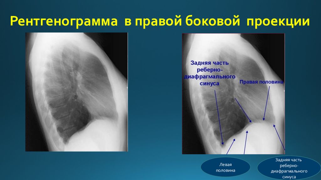 Реберно диафрагмальный синус. Гидроторакс рентген боковая проекция. Задний реберно диафрагмальный синус. Плеврит справа рентген боковая проекция. Пневмоторакс в боковой проекции рентген.