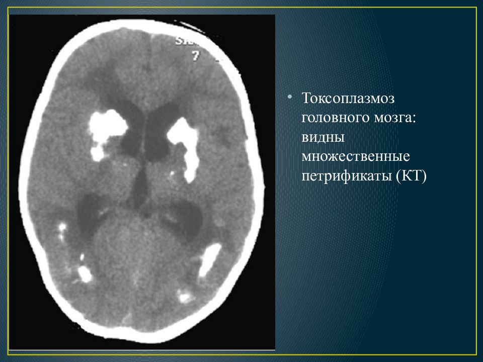 Токсоплазмоз головного мозга кт картина