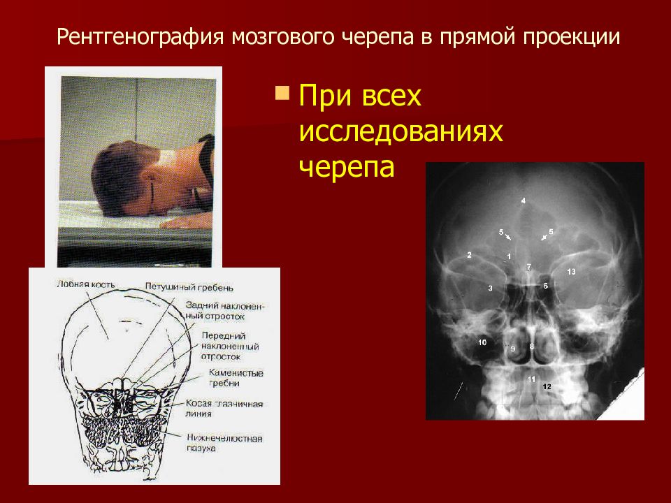 Рентгенография в прямой проекции. Рентген черепа в аксиальной проекции. Рентгенография черепа в прямой проекции. Укладка черепа в прямой проекции. Прямая проекция черепа рентгенограмма.