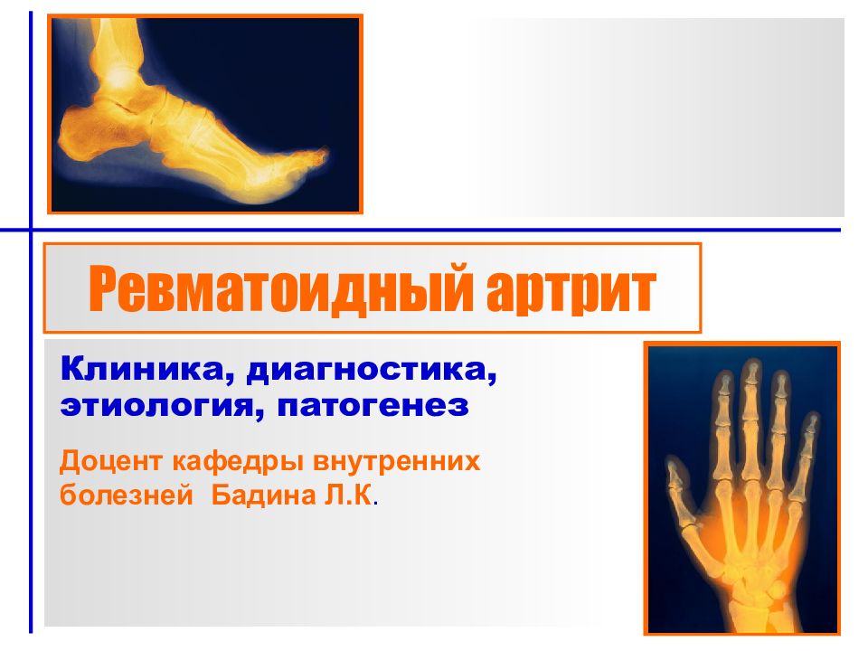 Ревматоидный артрит