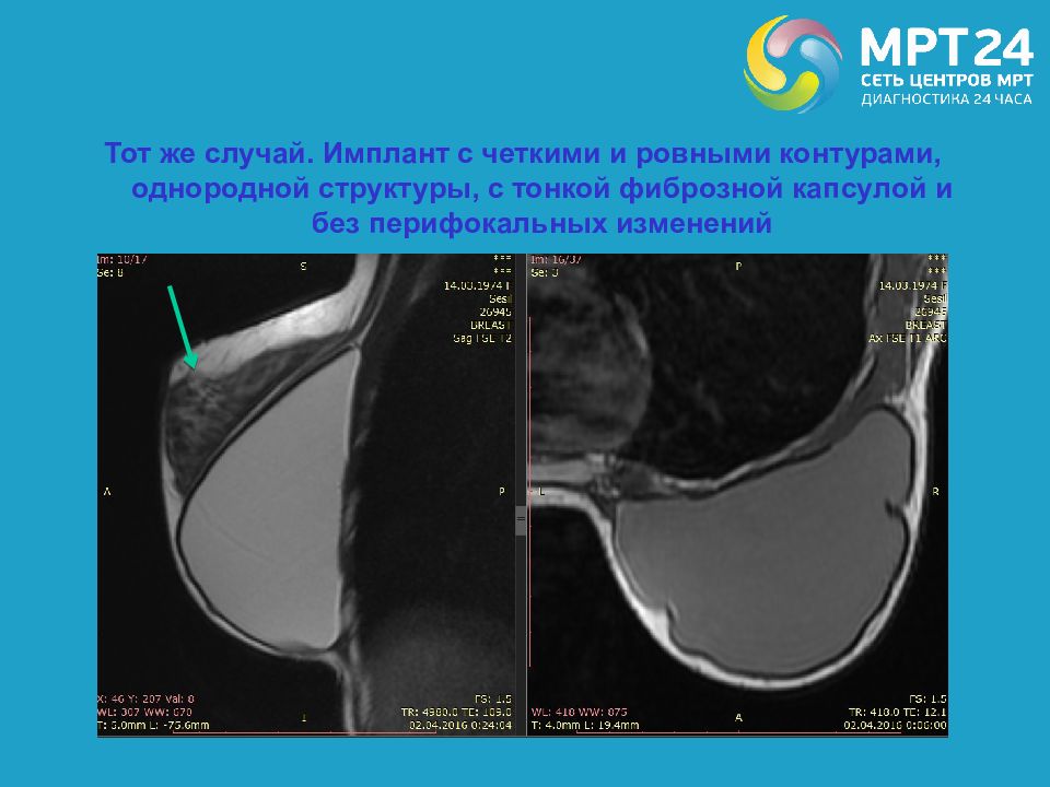 Контрактура молочной железы. Разрыв импланта молочной железы мрт. Кт молочных желез с имплантами. Мрт с имплантами грудных желез. Контрактура импланта мрт.