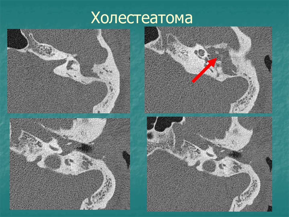 Сделать кт уха. Холестеатома среднего уха на кт. Холестеатома сосцевидного отростка кт. Холестеатома височной кости.