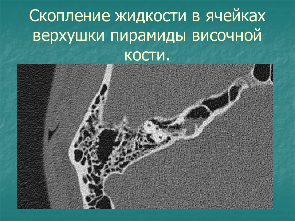 Пирамиды височной. Пирамида височной кости на кт. Верхушка пирамиды височной кости кт холестеатома. Скопление жидкости в ячейках верхушки пирамиды височной кости. Верхушка пирамиды височной кости кт.