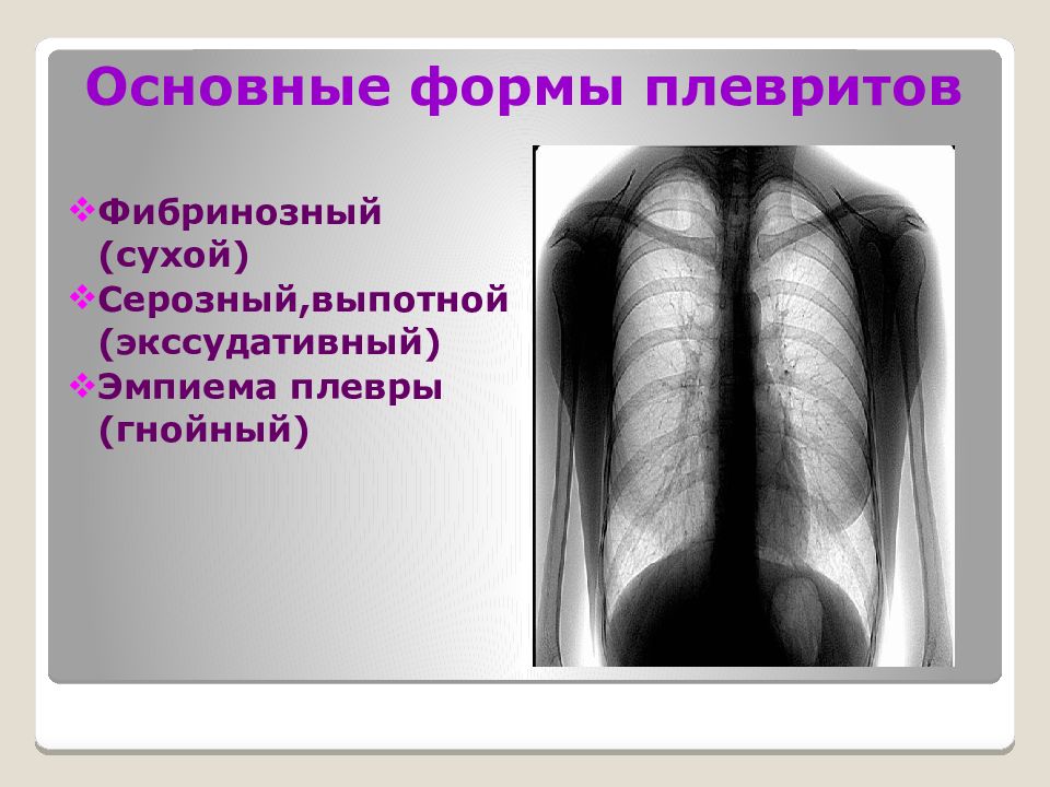 Сухой плеврит рентгенологическая картина