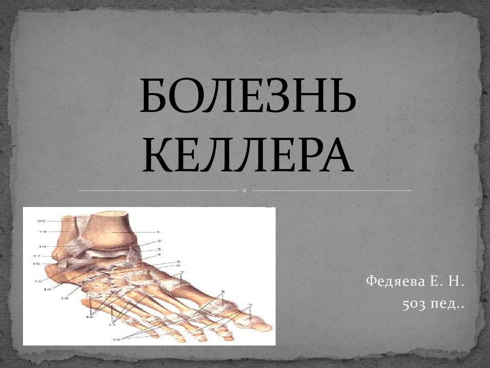 БОЛЕЗНЬ КЕЛЛЕРА