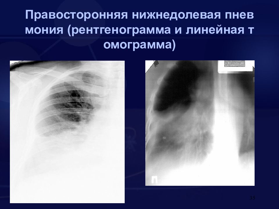 Правосторонняя нижнедолевая пневмония. Крупозная пневмония рентген. Нижнедолевая крупозная пневмония. Шаровидная пневмония рентген. Нижнедолевая крупозная пневмония рентген.