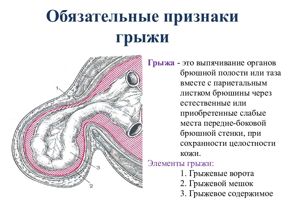 Признаки грыжи. Грыжи топографическая анатомия. Грыжа передней брюшной стенки мкб.