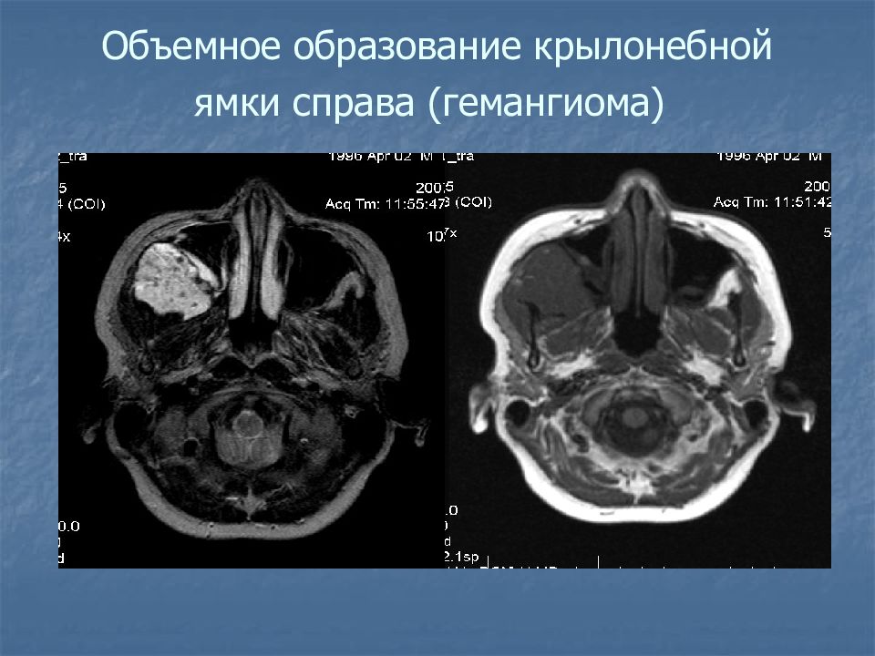 Крылонебная ямка стенки сообщения