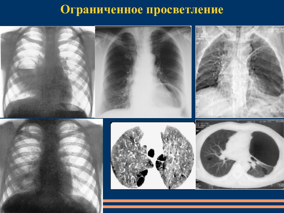 Просветление в легких. Ограниченное просветление легочного поля. Ограниченное просветление на рентгене. Ограниченное просветление в легких. Синдром ограниченного просветления.