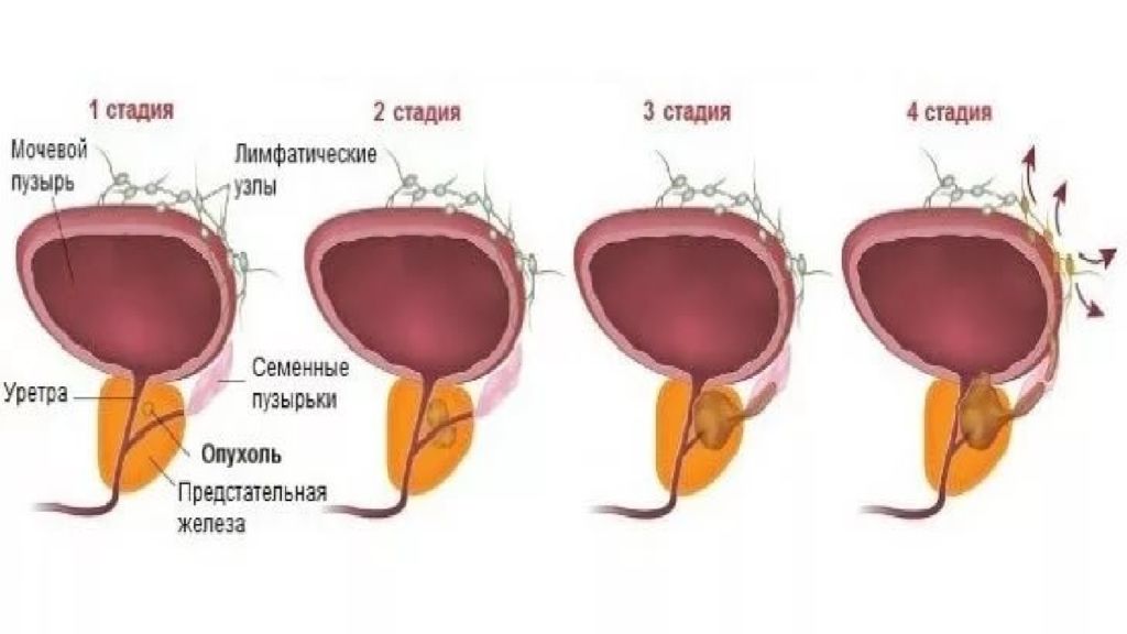 Стадии рака простаты. Опухоли семенных пузырьков. Опухоли семенных пузырьков презентация. Онкология семенных пузырьков.