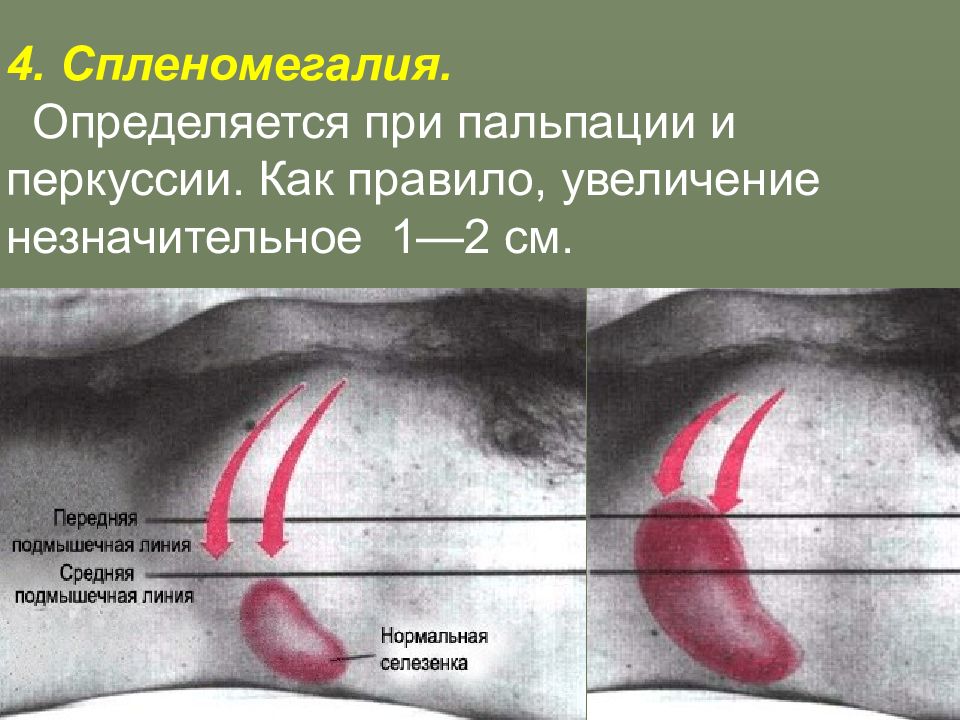 Спленомегалия что это такое у взрослых печени. Спленомегалия определяется при:. Спленомегалия этиология патогенез клиника. Спленомегалия осложнения.