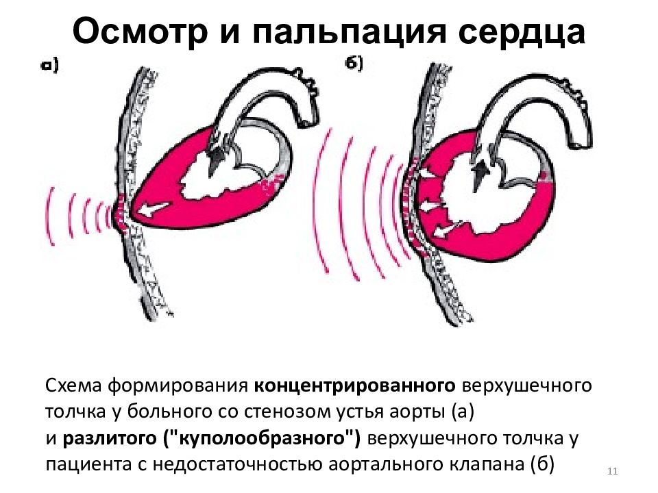 Недостаточность трехстворчатого клапана рисунок