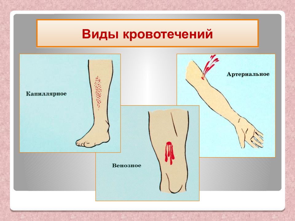 Капиллярное кровотечение первая помощь картинки