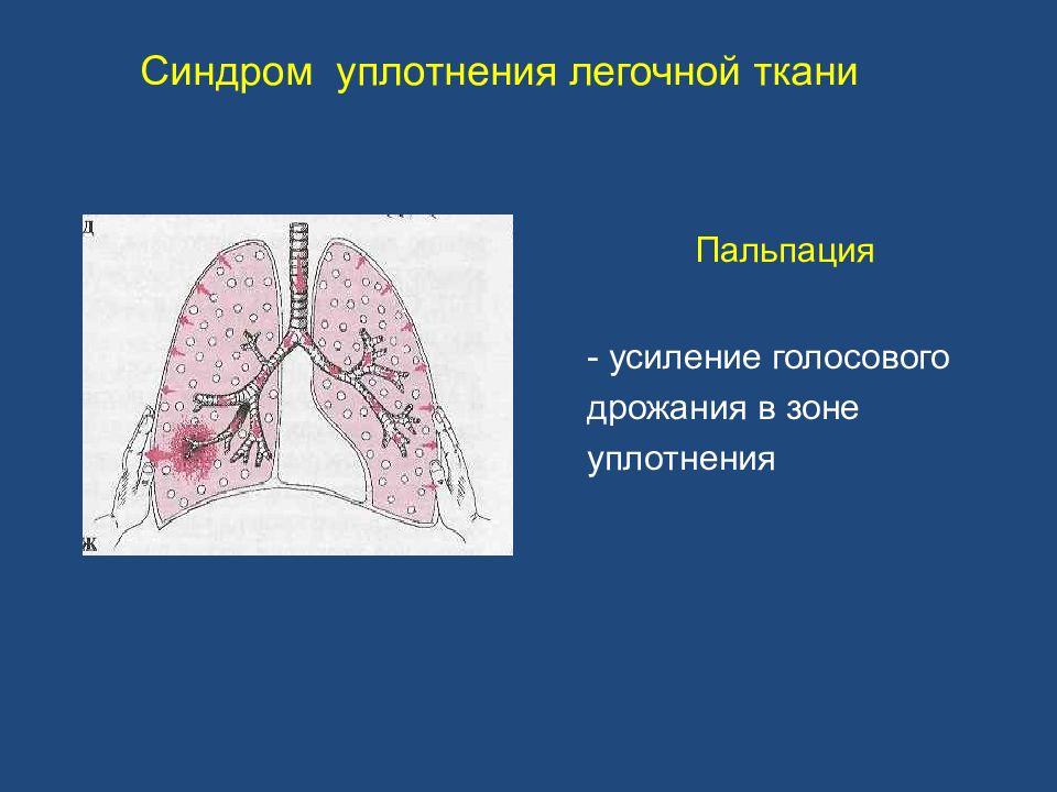 Уплотнение легочного рисунка