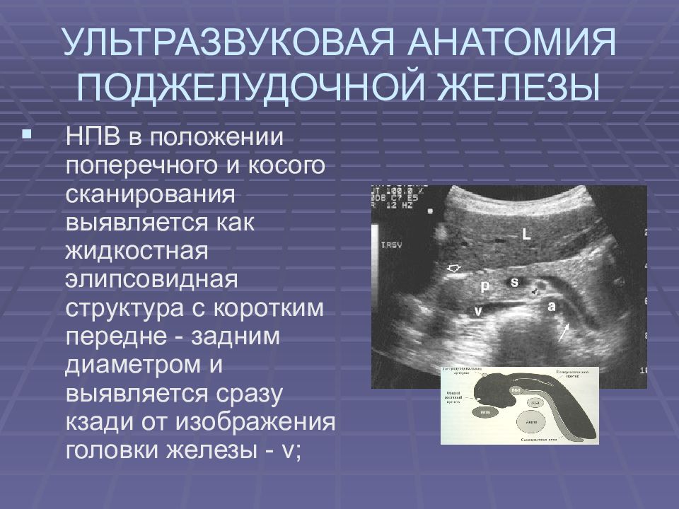 Эхографическую картину кисты поджелудочной железы необходимо дифференцировать с тест