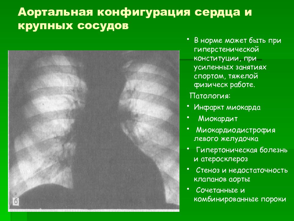 Конфигурация сердца. Аортальная недостаточность конфигурация сердца. Аортальная конфигурация сердца при. Рентгенологические признаки аортальной конфигурации сердца. Аортальная конфигурация сердца рентген признаки.