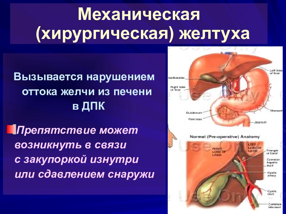 Хирургия механическая желтуха презентация