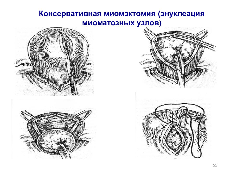 Перекрут придатков матки презентация