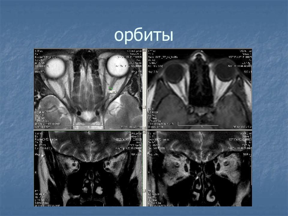 Объемное образование левой. Оценка мрт. Методика оценки мрт изображения. Методика оценки мрт изображений головного мозга. Программа для чтения изображений мрт.