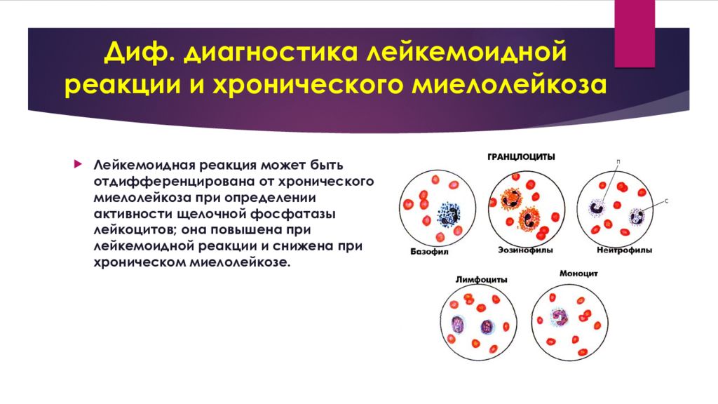 Лейкозы лейкемоидные реакции. Дифференциальная диагностика хронического миелолейкоза. Диф диагноз хронического миелолейкоза. Дифференциальная диагностика острого и хронического миелолейкоза. Лейкемоидная реакция дифференциальная диагностика.