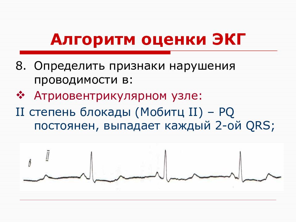 Схема оценки экг