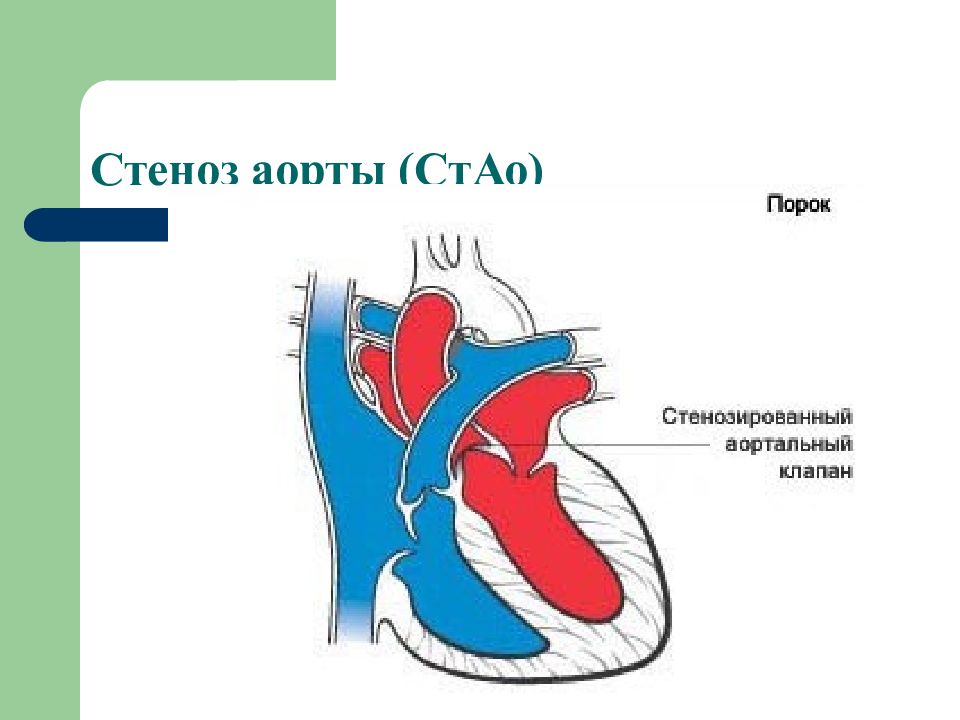 Пороки сердца презентация. Врожденный стеноз устья аорты.