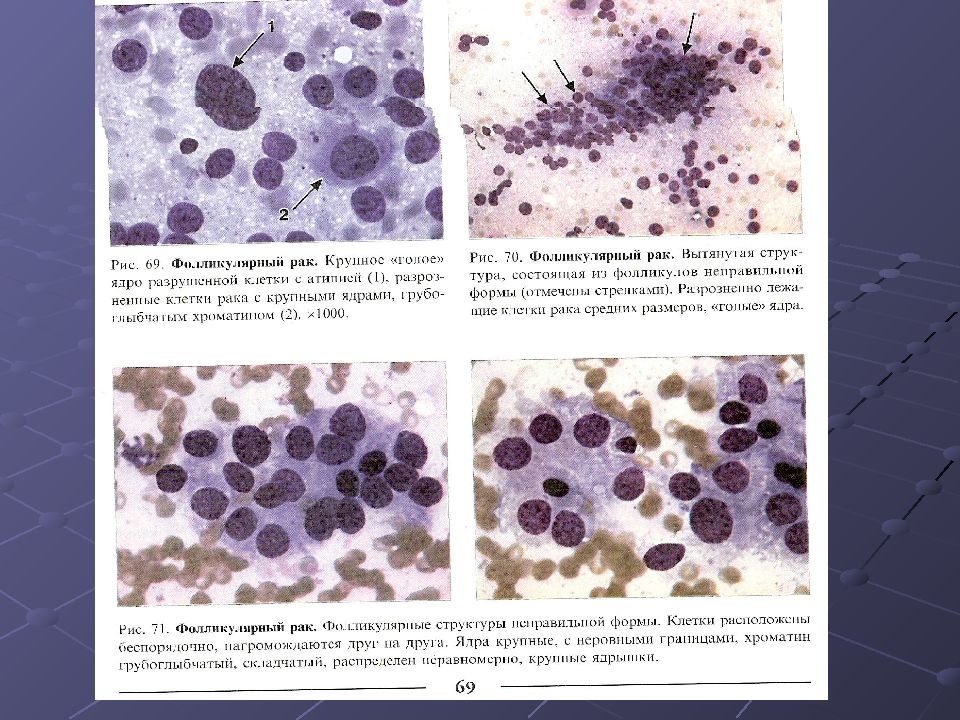 Цитологическая картина папиллярной карциномы щитовидной железы