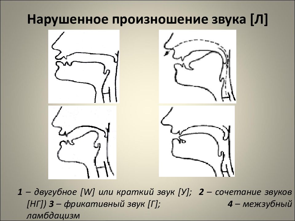 Положение л. Нарушения произношения звуков л л. Двугубный ламбдацизм. Межзубный ламбдацизм. Губно-губной ламбдацизм.