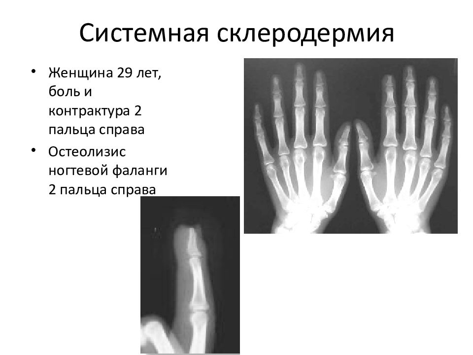 Артропатия что это Артропатия что это