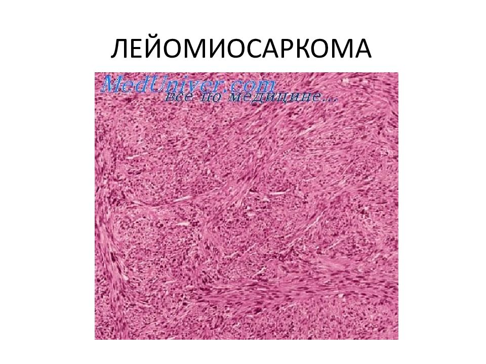 Лейомиосаркома. Лейомиосаркома патанатомия. Лейомиосаркома препарат. Лейомиосаркома тонкого кишечника. Лейомиосаркома патологическая анатомия.