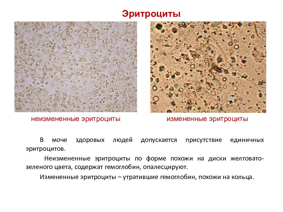 Эритроциты в моче картинки