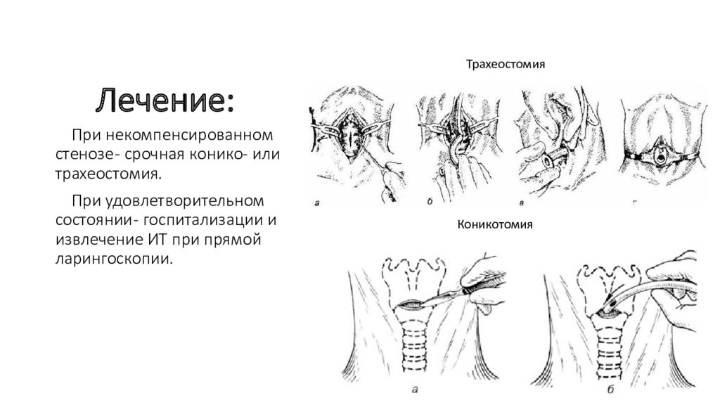 Трахеостомия. Техника трахеостомии у детей. Конико или трахеостомия.