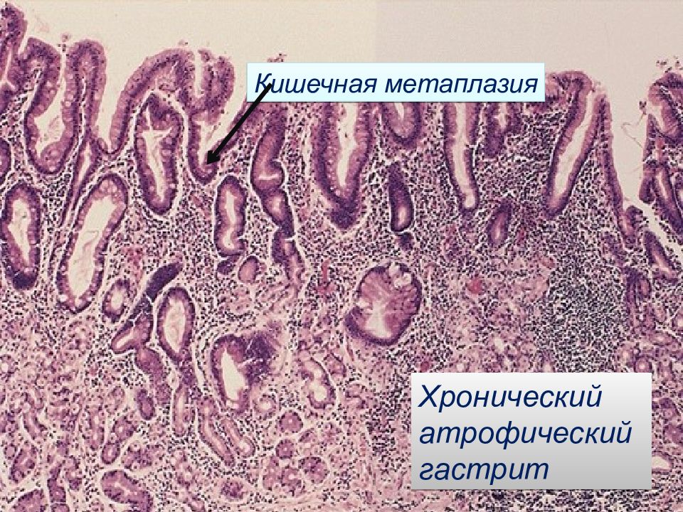 Атрофический гастрит. Хронический гастрит гистология. Кишечная метаплазия желудка гистология. Хронический гастрит с кишечной метаплазией микропрепарат. Атрофический гастрит патанатомия.