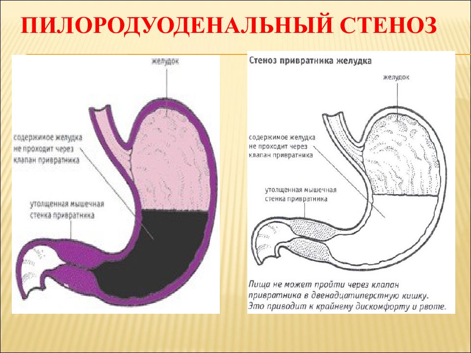 Презентация осложнения язвенной болезни желудка и двенадцатиперстной кишки